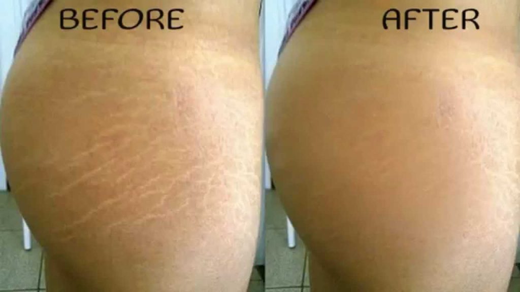 Bio oil before and after stretch marks