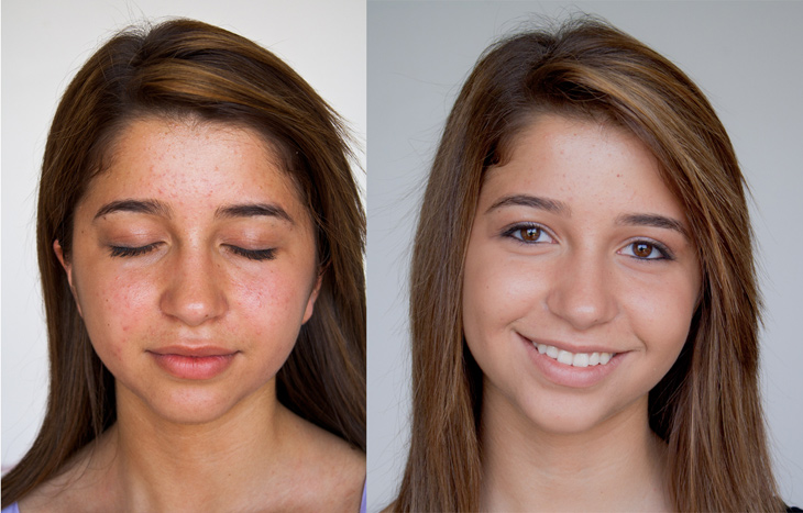 Bio Oil Before And After On Face